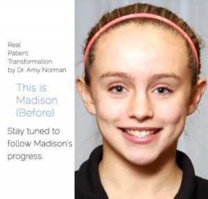 Patient Transformation: Madison Amy Norman, DDS - Everett, WA