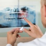 Dental Implants vs Dentures: 3 Reasons Implants Are Better