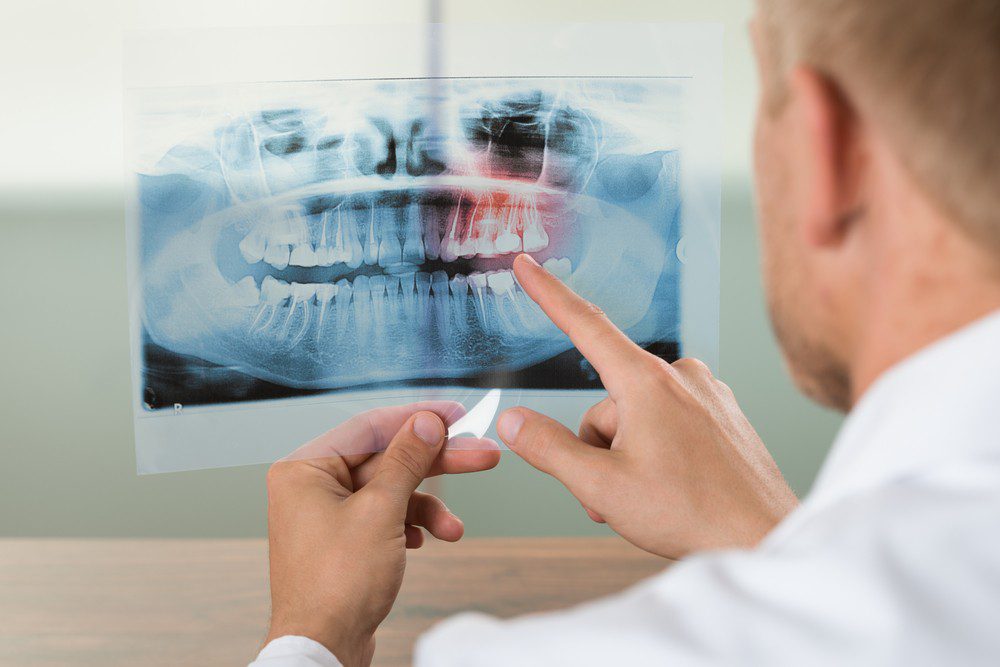 Dental Implants vs Dentures: 3 Reasons Implants Are Better