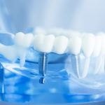 Dental Implant Recovery Time