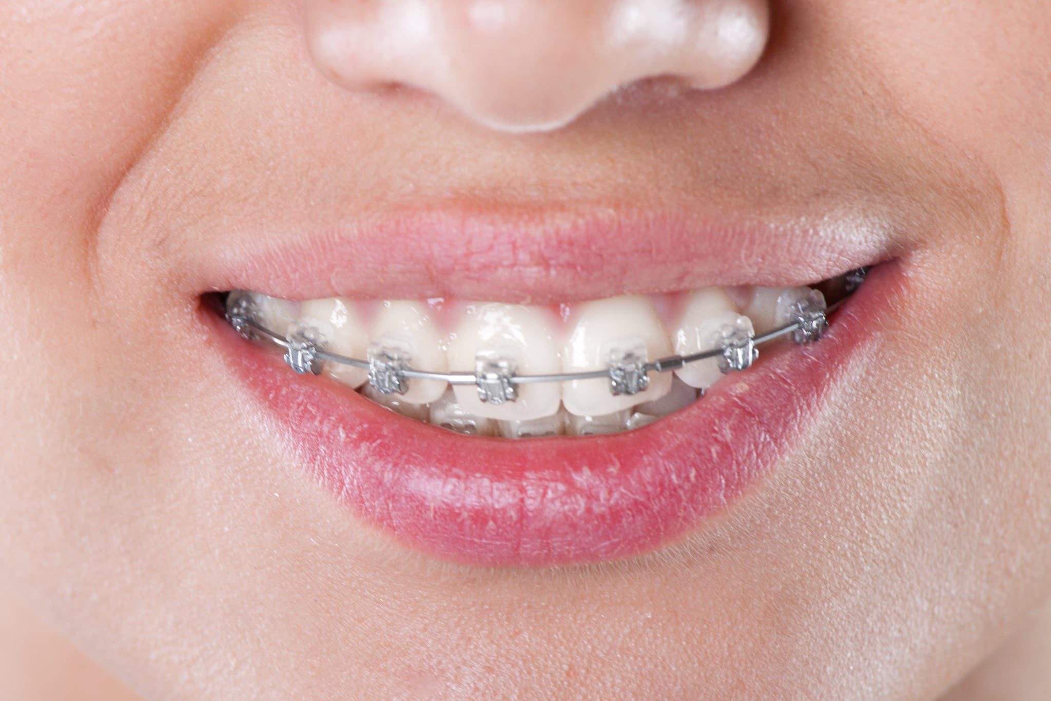 Close-up of a smile with braces, unrelated to dental implant surgery.